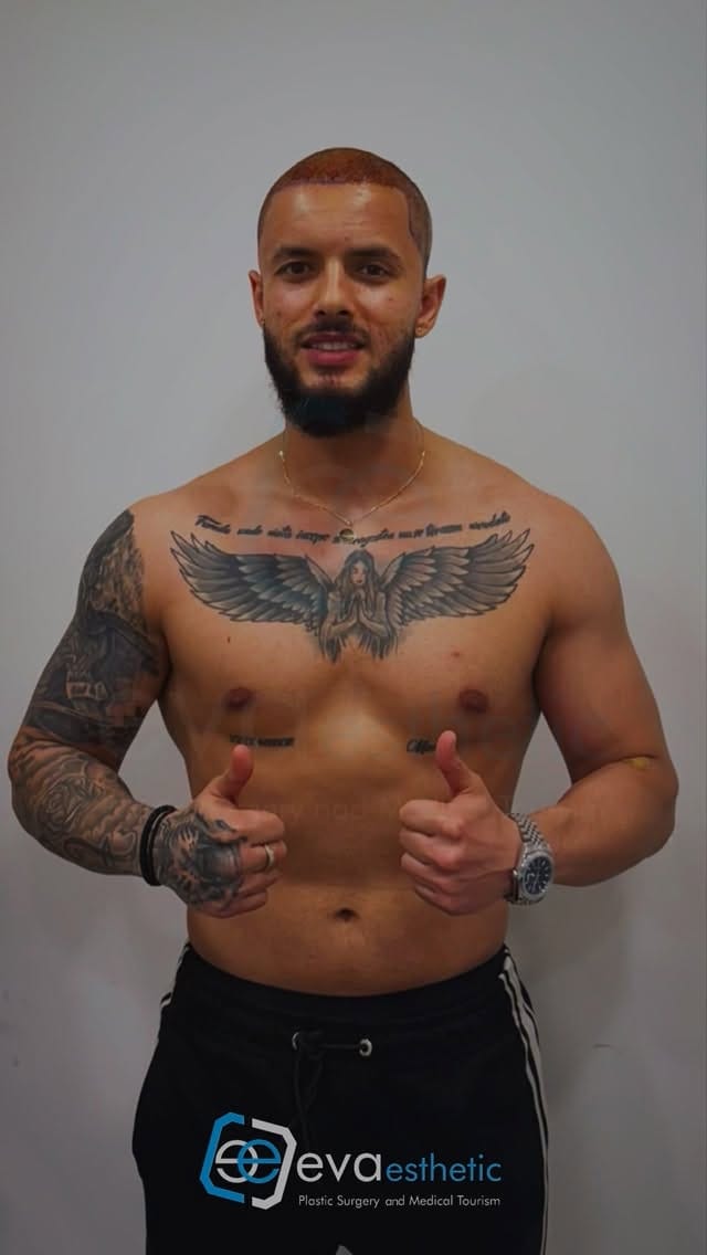 Post 5 by Hair Taransplant In Turkey on Instagram (video)