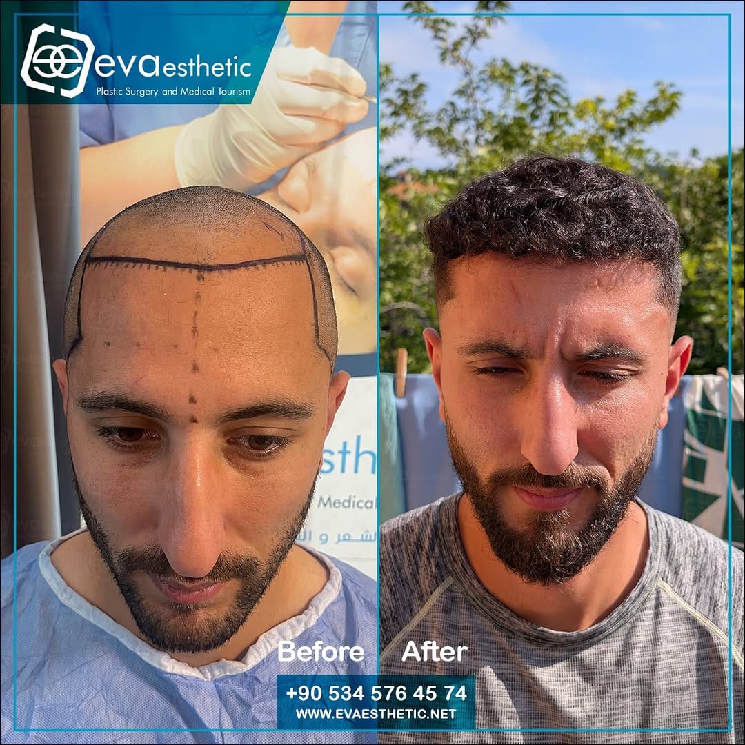 Post 4 by Hair Taransplant In Turkey on Instagram (carousel)