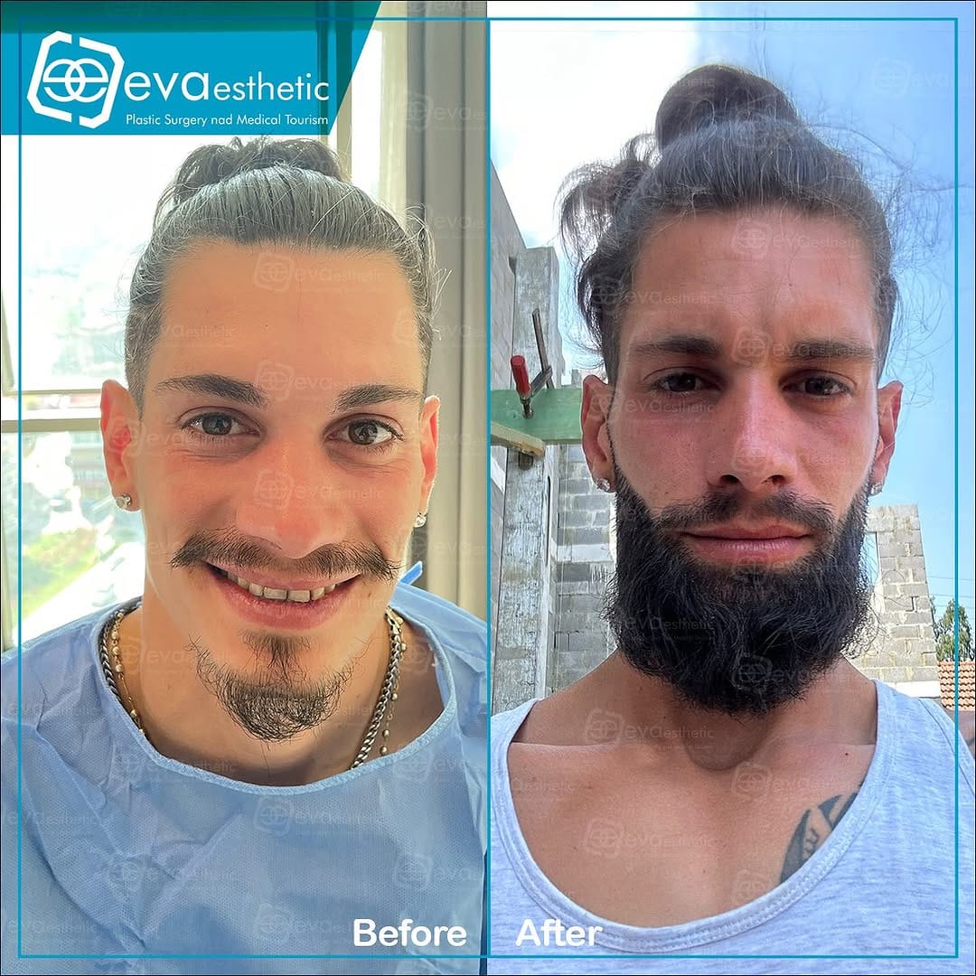 Post 9 by Hair Taransplant In Turkey on Instagram (carousel)