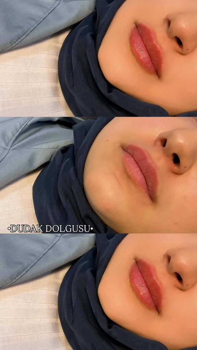 Post 1 by Derma Skins on Instagram (video)