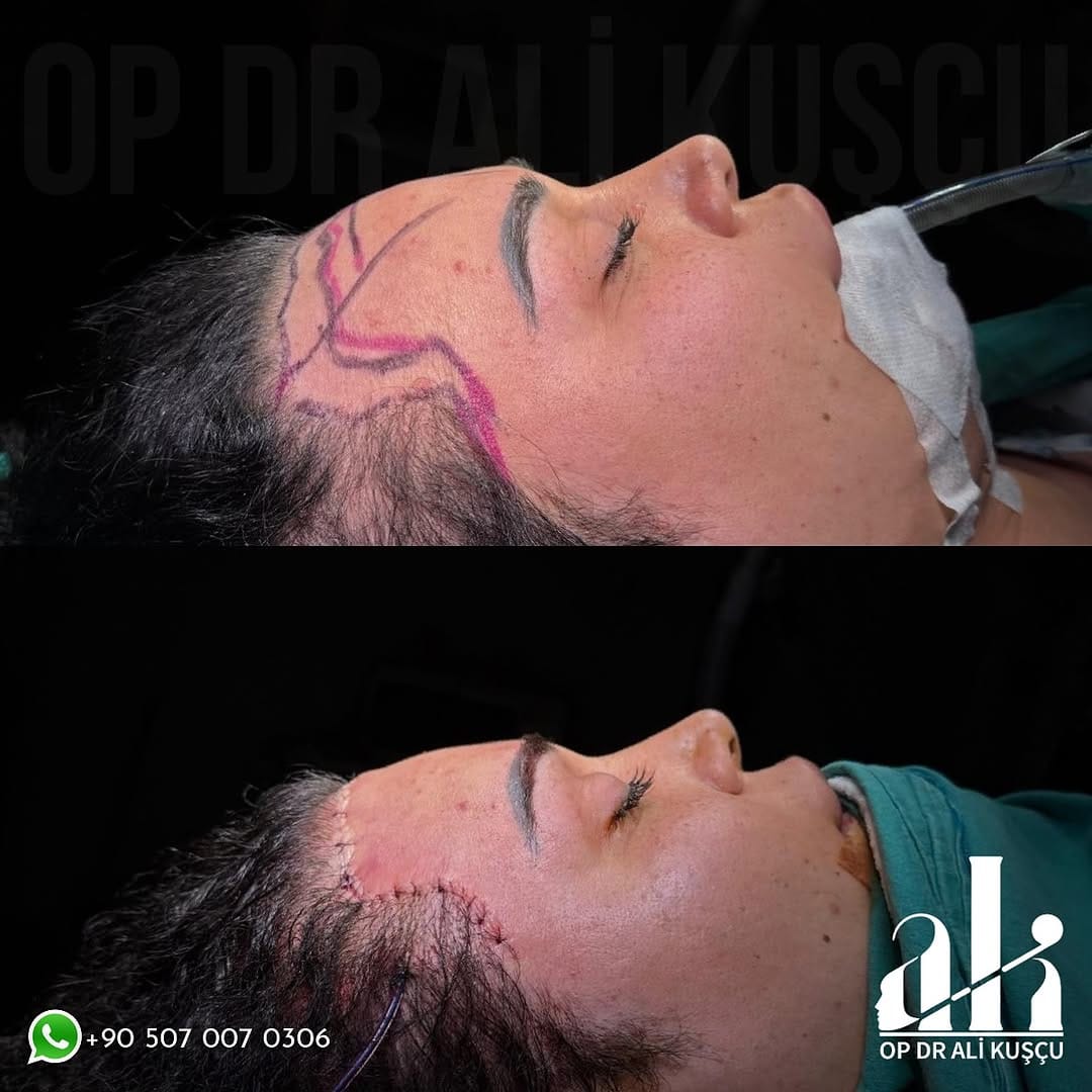 Post 6 by Op. Dr. Ali KUŞÇU (Ali QUSHCHI) on Instagram (carousel)