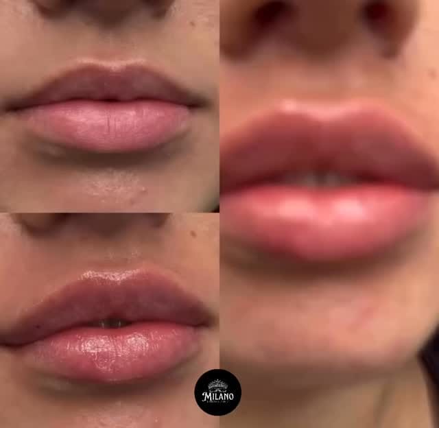 Post 7 by Bakırköy Milano Estetica Clinic on Instagram (video)