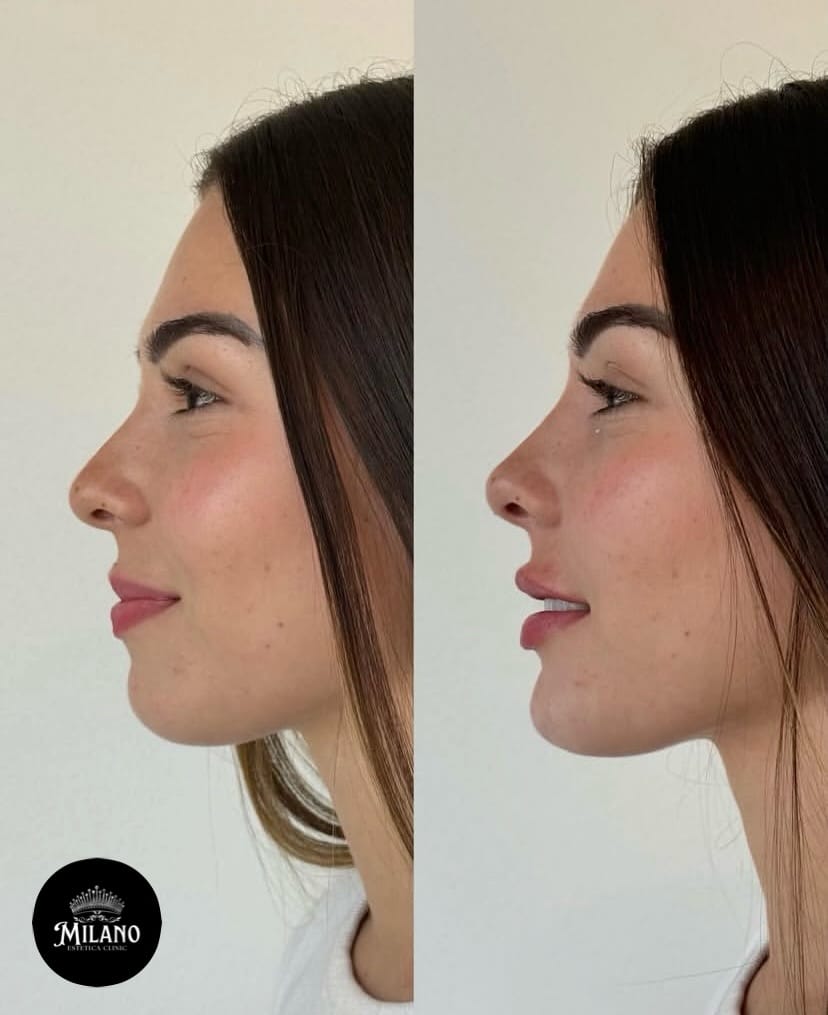 Post 6 by Bakırköy Milano Estetica Clinic on Instagram (carousel)