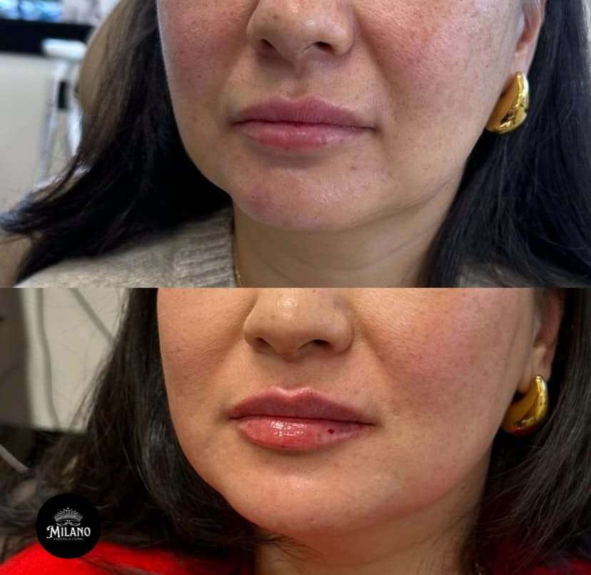 Post 4 by Bakırköy Milano Estetica Clinic on Instagram (image)