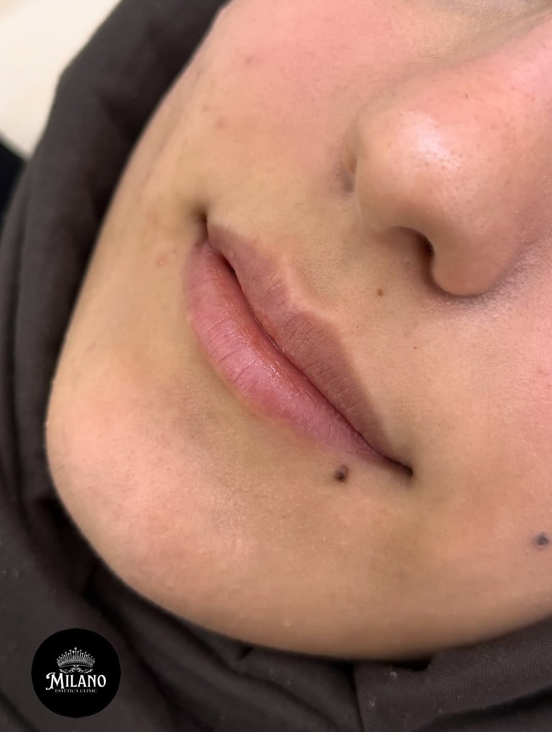 Post 9 by Bakırköy Milano Estetica Clinic on Instagram (carousel)