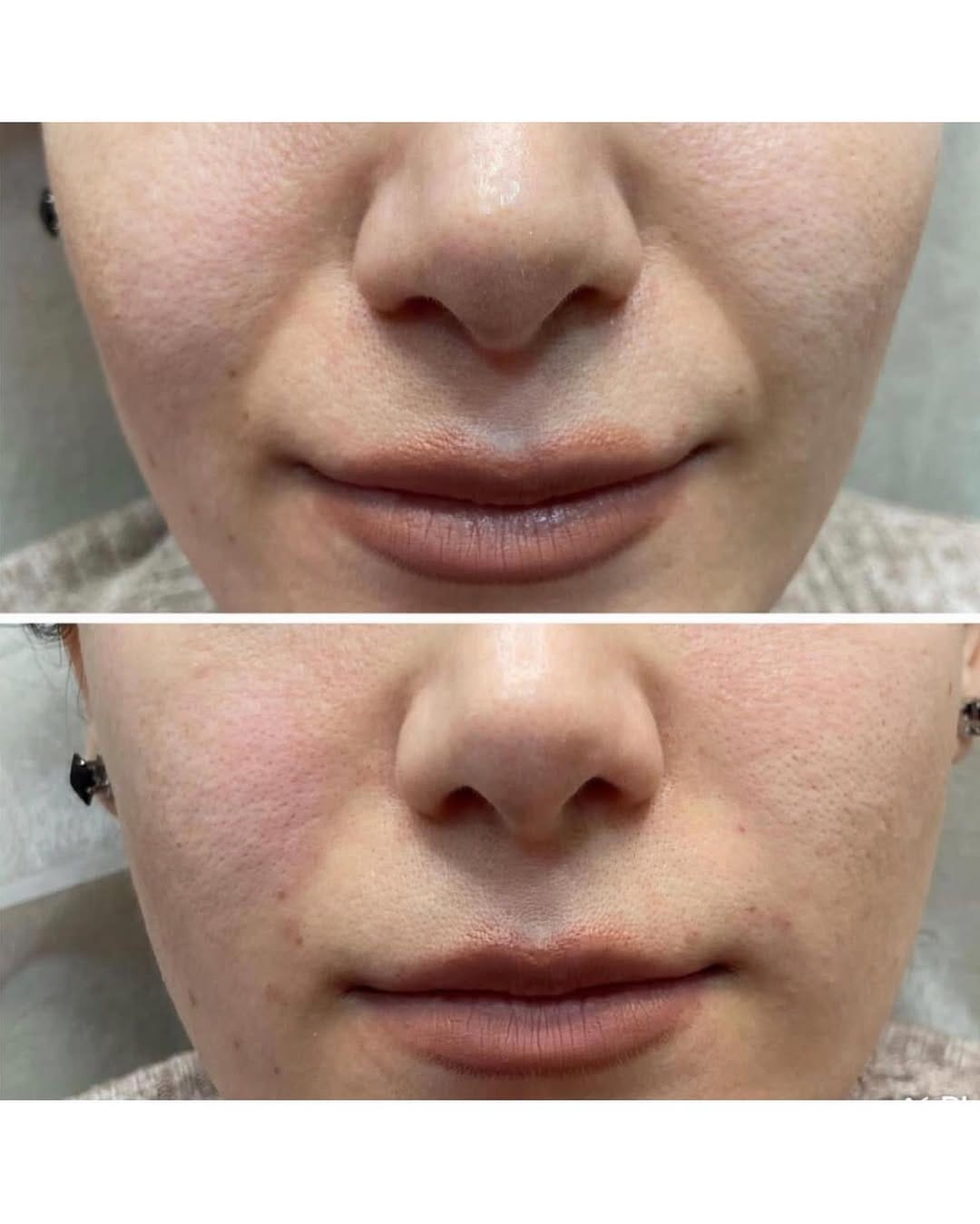 Post 2 by @newdermklinik on Instagram (image)