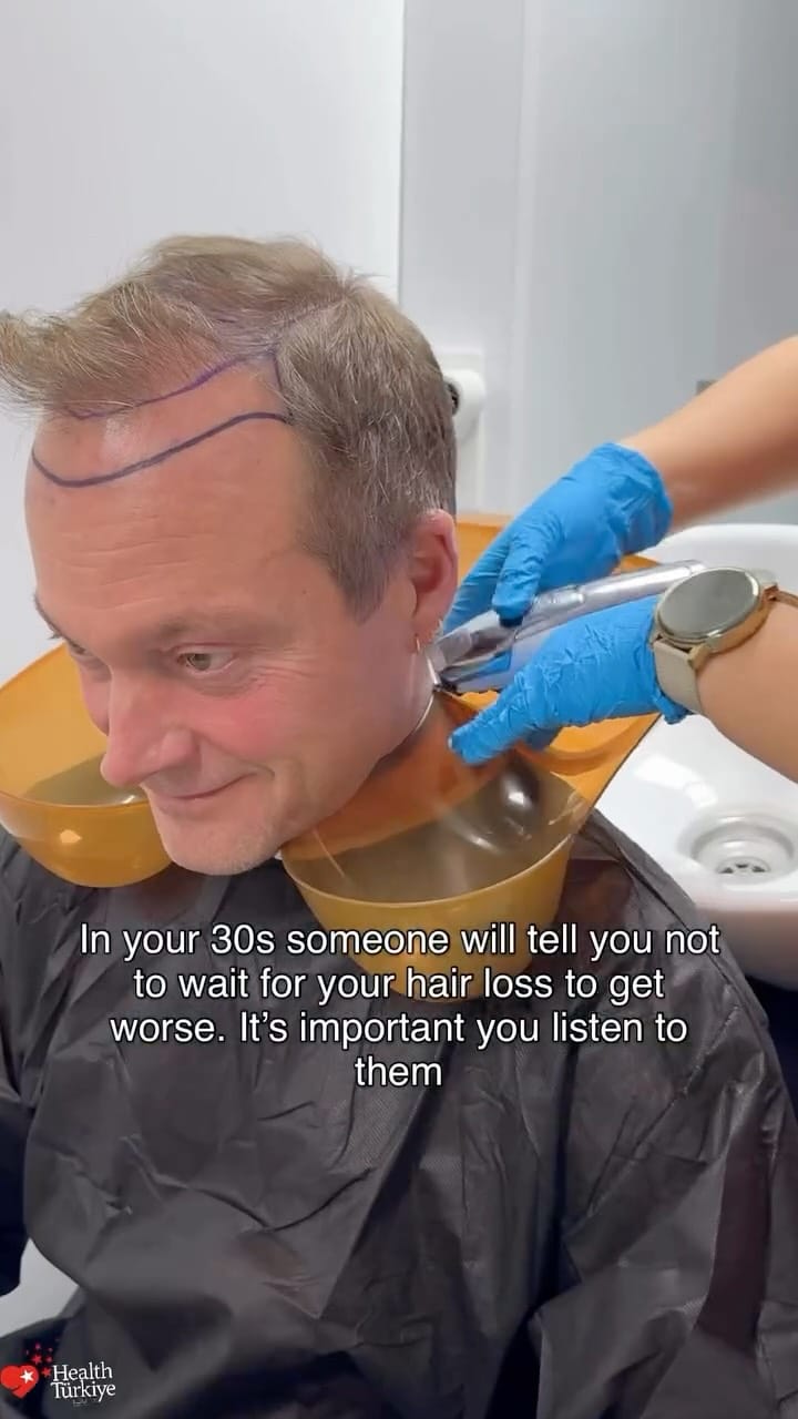 Post 3 by MCAN Health | Hair Transplant on Instagram (video)