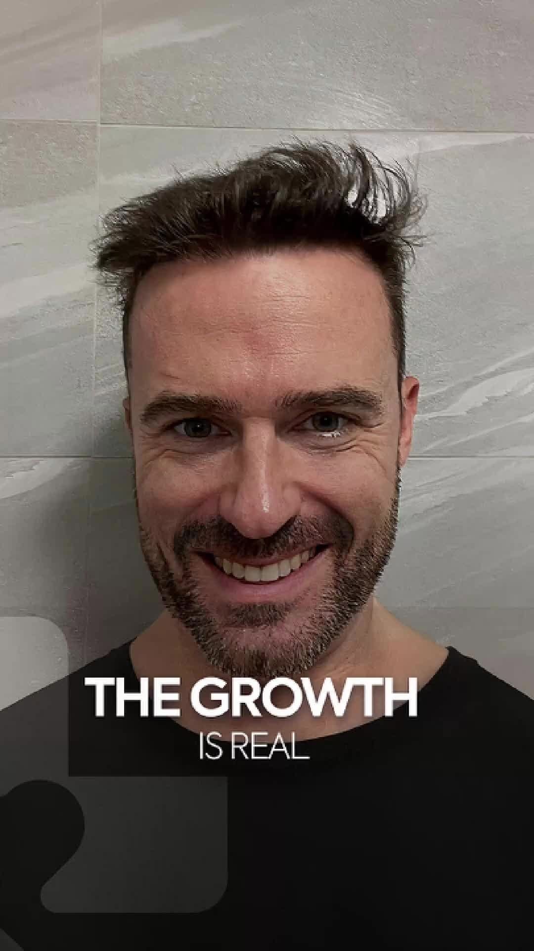 Post 8 by MCAN Health | Hair Transplant on Instagram (video)
