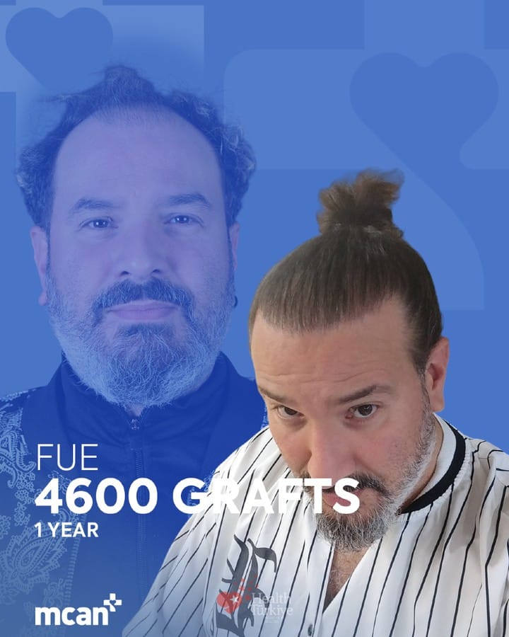 Post 5 by MCAN Health | Hair Transplant on Instagram (carousel)