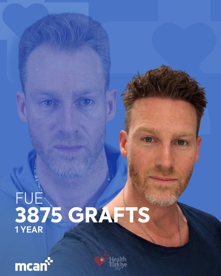 Post 6 by MCAN Health | Hair Transplant on Instagram (carousel)