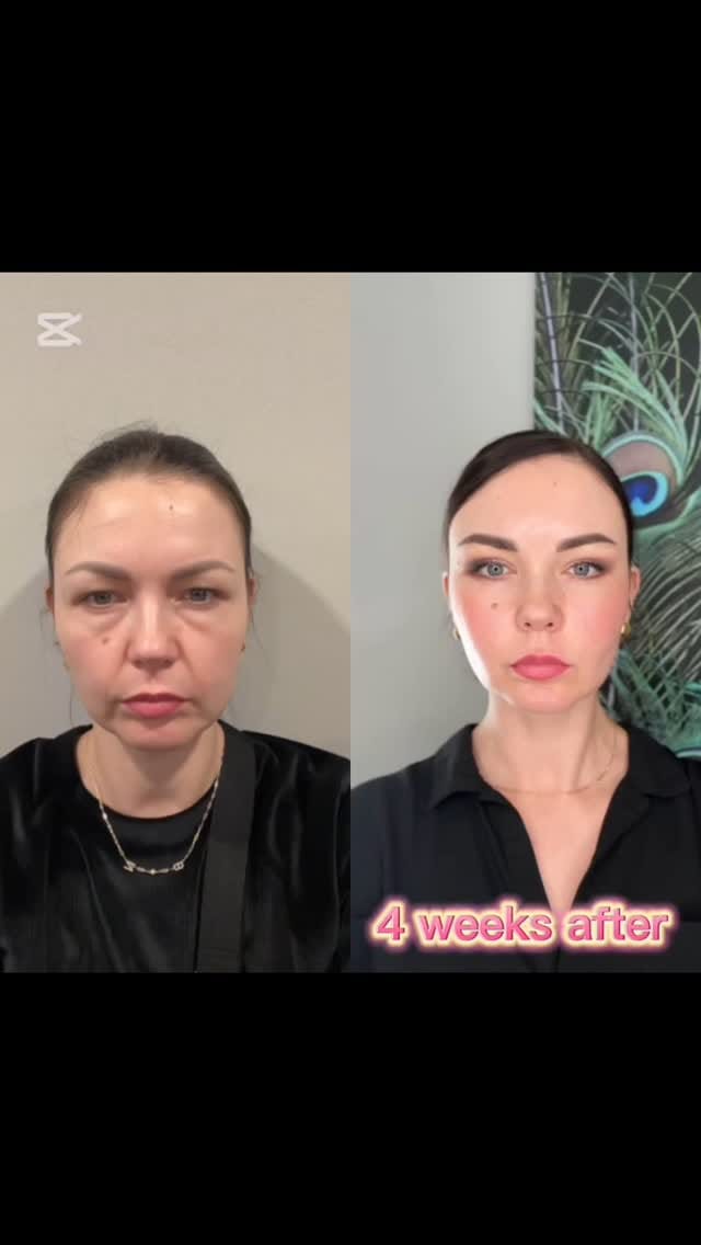 Post 6 by Ercan Karacaoglu M.D. on Instagram (video)