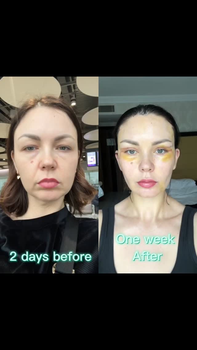 Post 7 by Ercan Karacaoglu M.D. on Instagram (video)