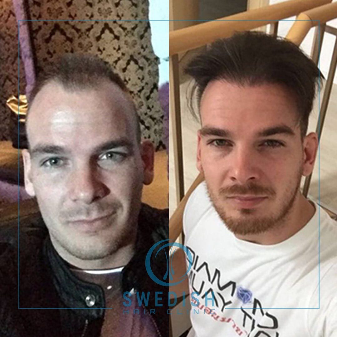 Post 1 by Swedish Hair Clinic on Instagram (image)