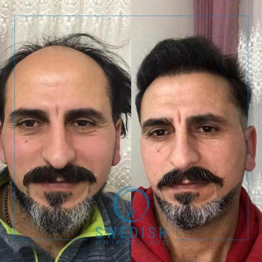 Post 4 by Swedish Hair Clinic on Instagram (image)