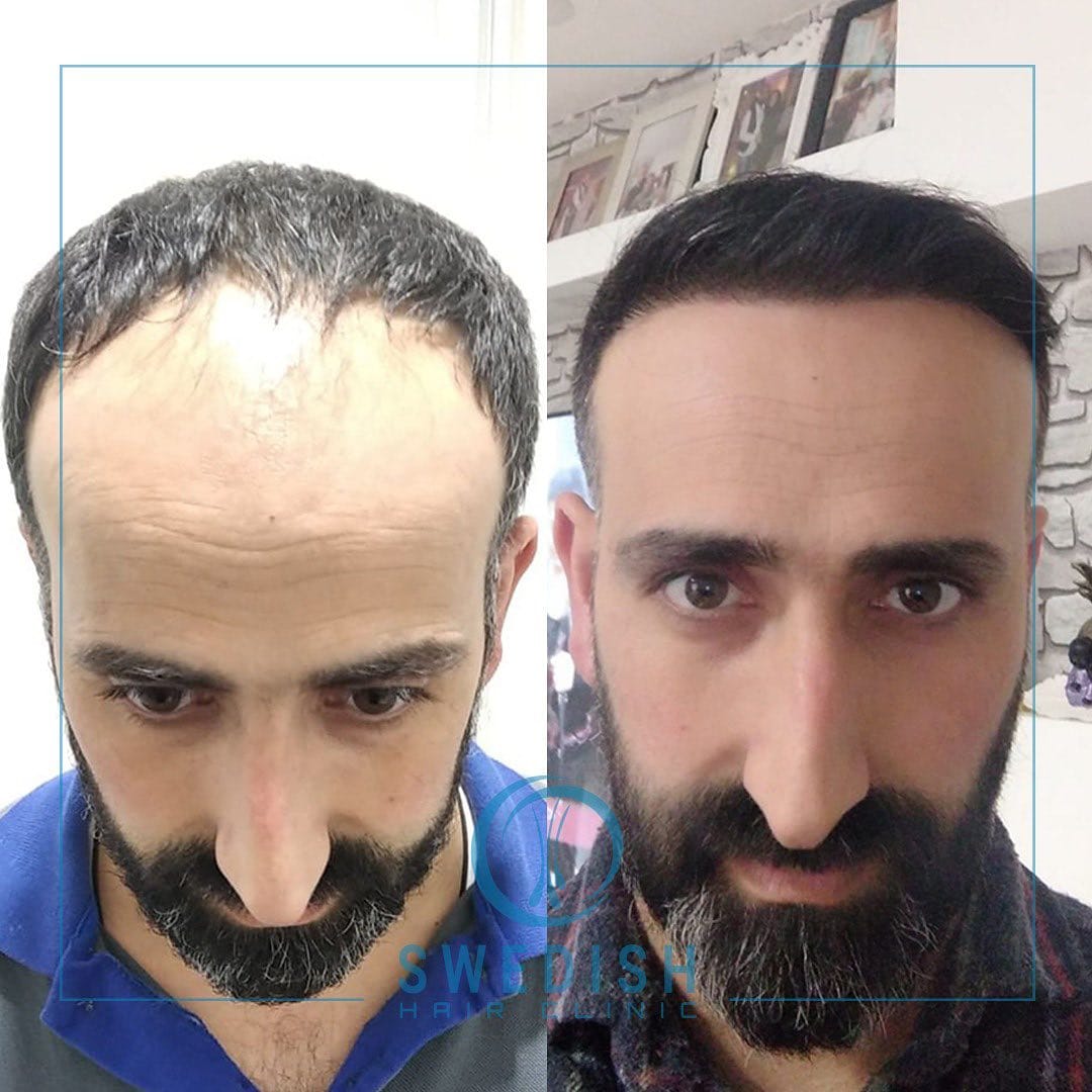 Post 7 by Swedish Hair Clinic on Instagram (image)