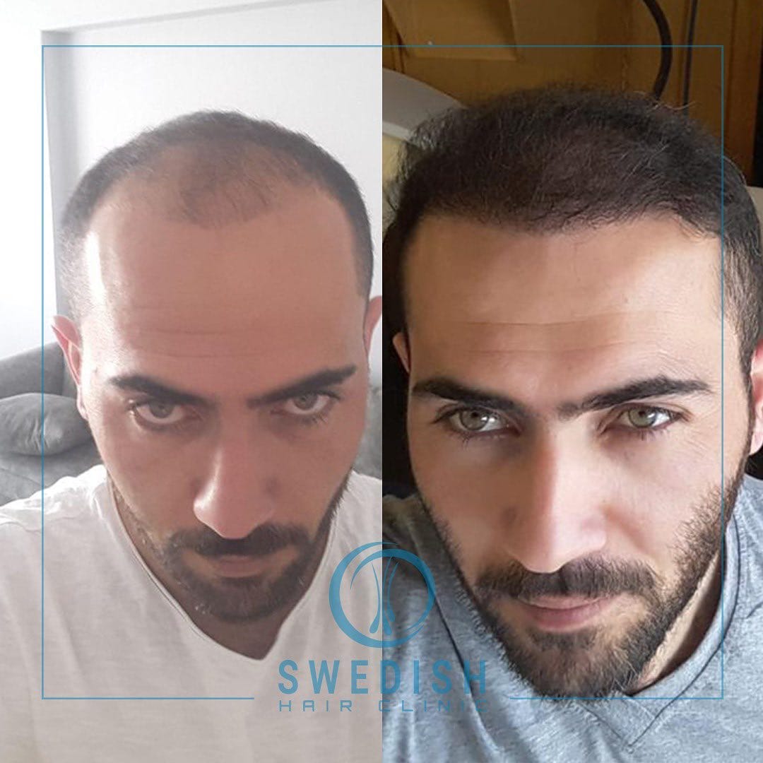 Post 10 by Swedish Hair Clinic on Instagram (image)
