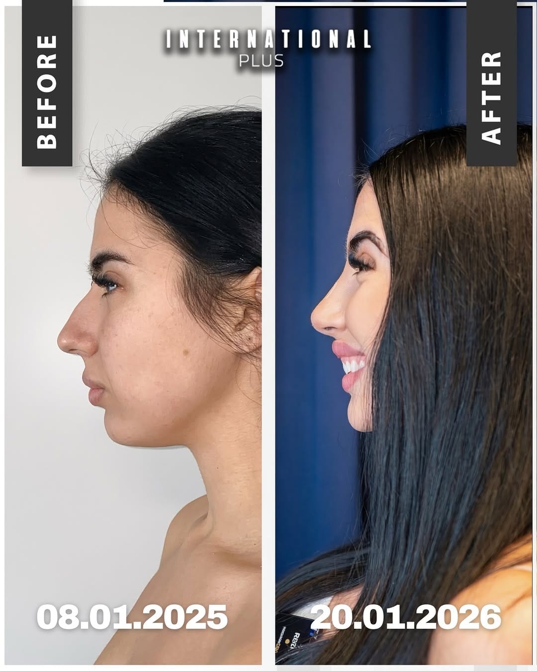 Post 1 by Plastic Surgery Istanbul on Instagram (image)