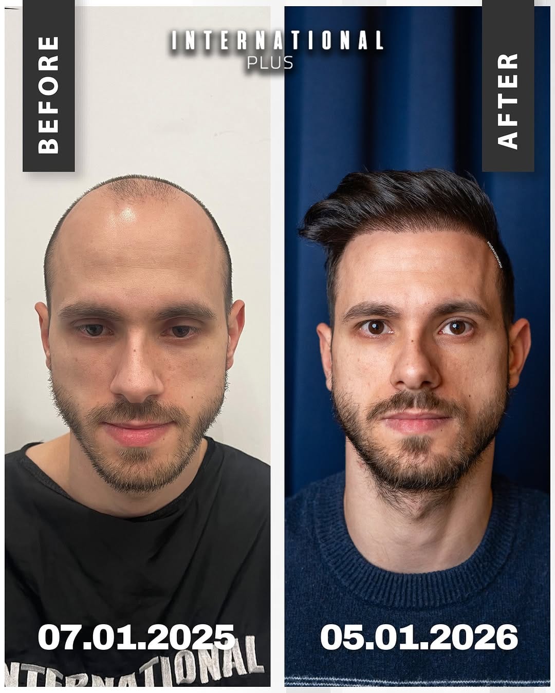 Post 10 by Plastic Surgery Istanbul on Instagram (image)
