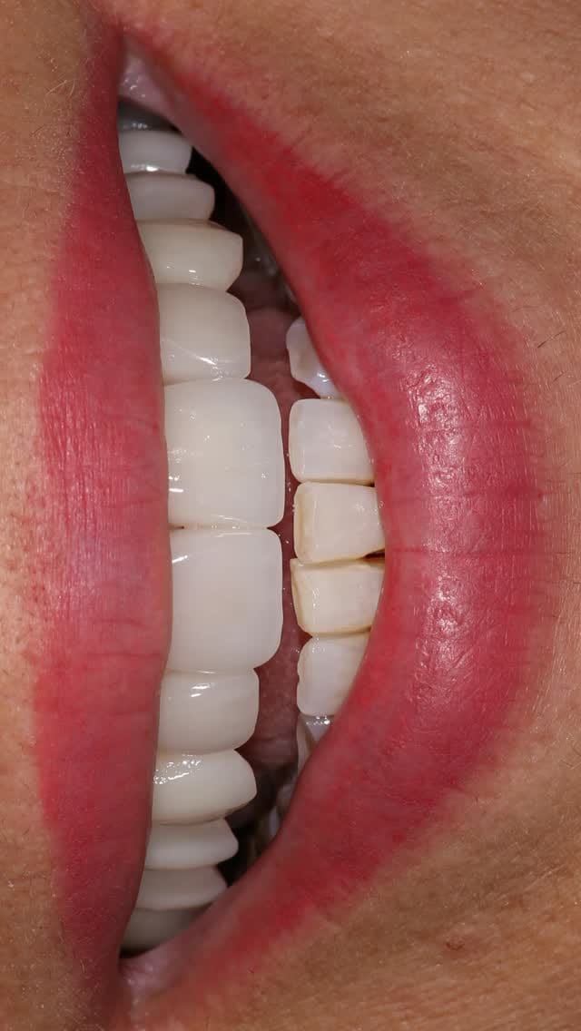 Post 4 by Doç.Dr. Elif ÖNCÜ | Diş Hekimi | İmplantoloji | Ankara on Instagram (video)