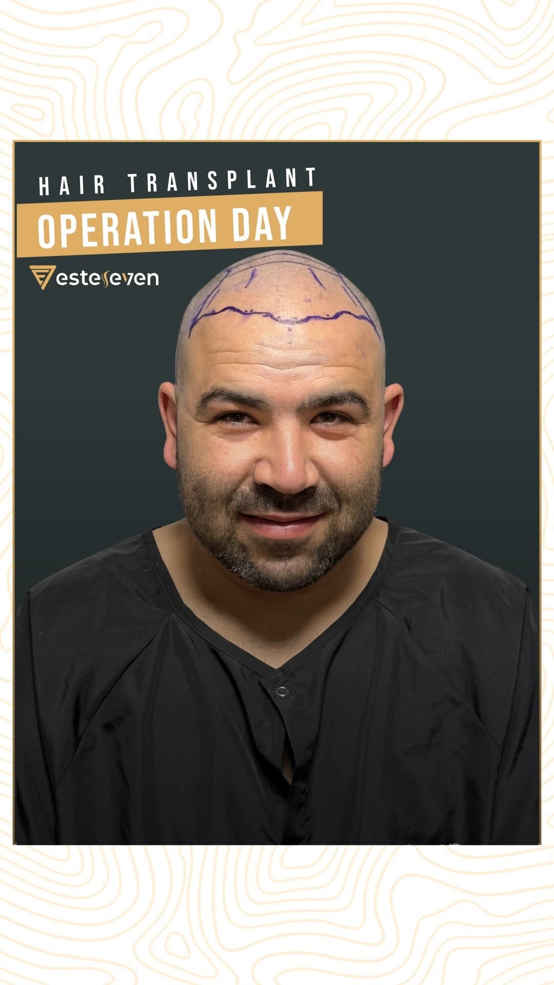 Post 6 by Esteseven Hair Transplant on Instagram (video)