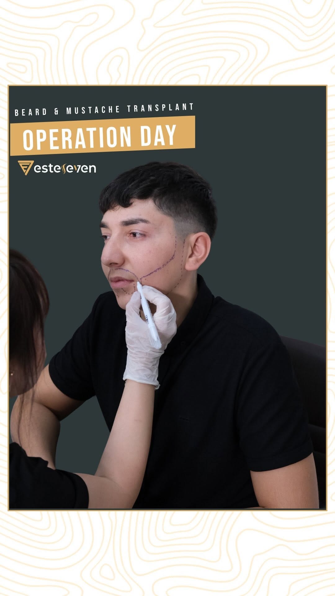 Post 3 by Esteseven Hair Transplant on Instagram (video)