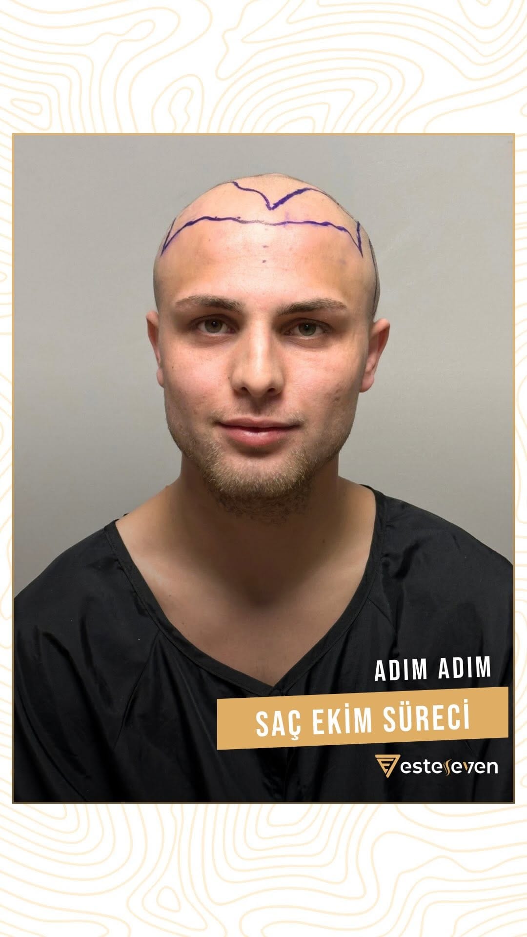 Post 9 by Esteseven Hair Transplant on Instagram (video)