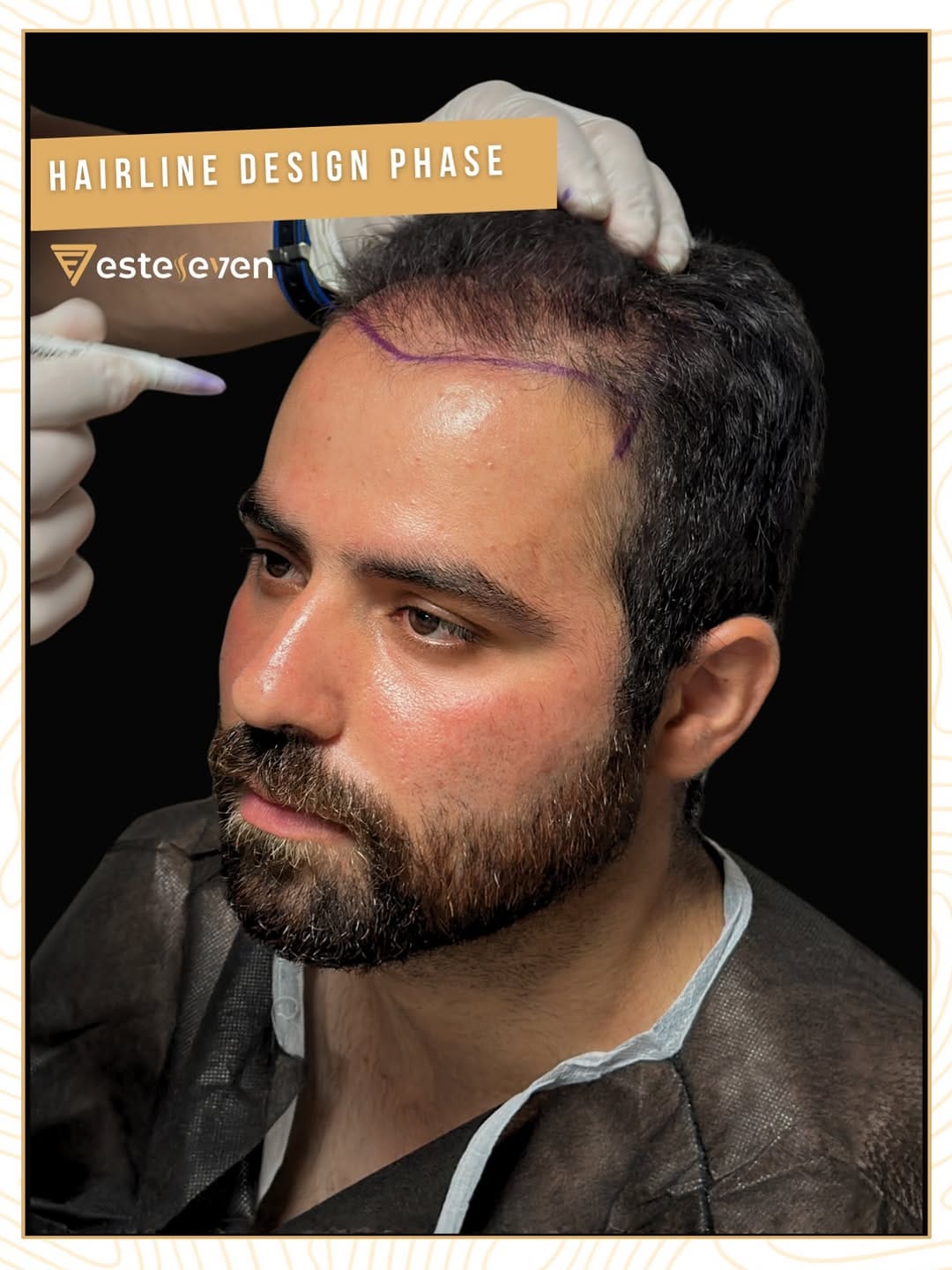 Post 5 by Esteseven Hair Transplant on Instagram (image)