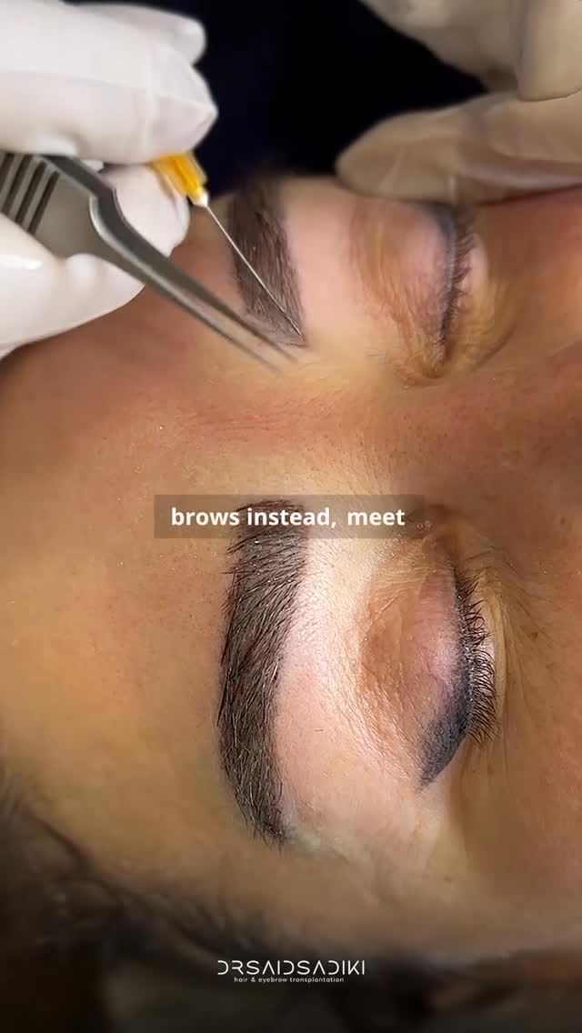Post 1 by Eyebrow Transplantation on Instagram (video)