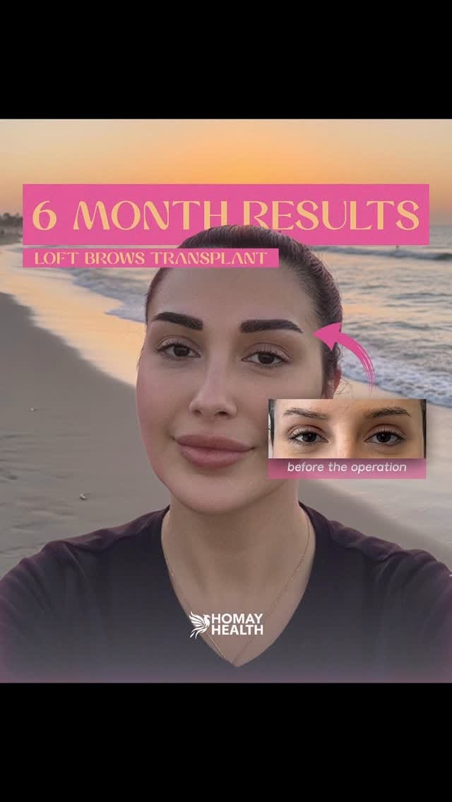 Post 7 by Eyebrow Transplantation on Instagram (video)