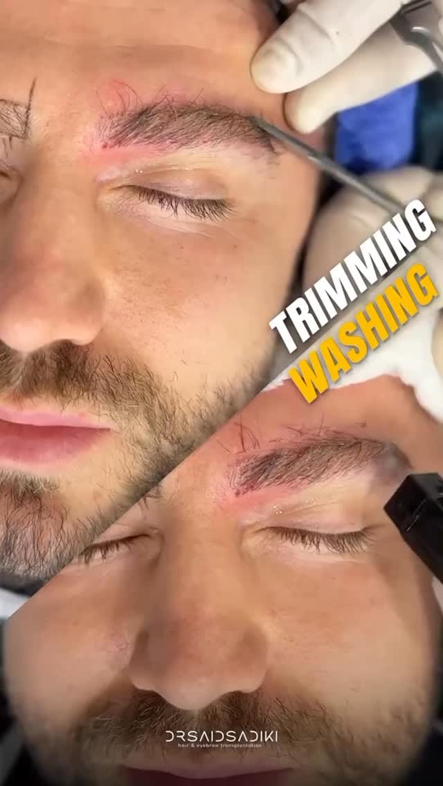 Post 4 by Eyebrow Transplantation on Instagram (video)