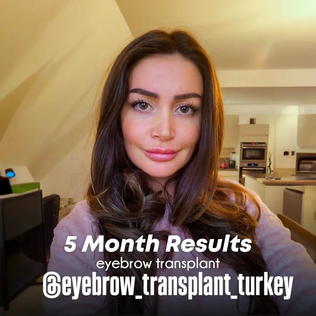 Post 2 by Eyebrow Transplantation on Instagram (image)