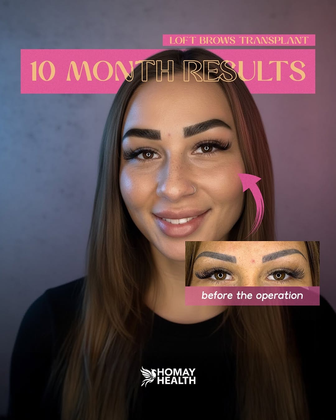 Post 10 by Eyebrow Transplantation on Instagram (image)