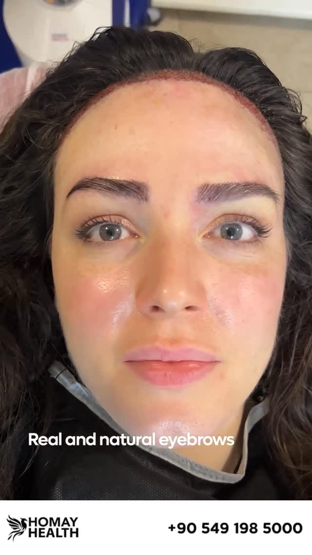 Post 3 by Eyebrow Transplantation on Instagram (video)
