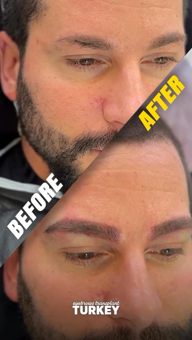 Post 9 by Eyebrow Transplantation on Instagram (video)
