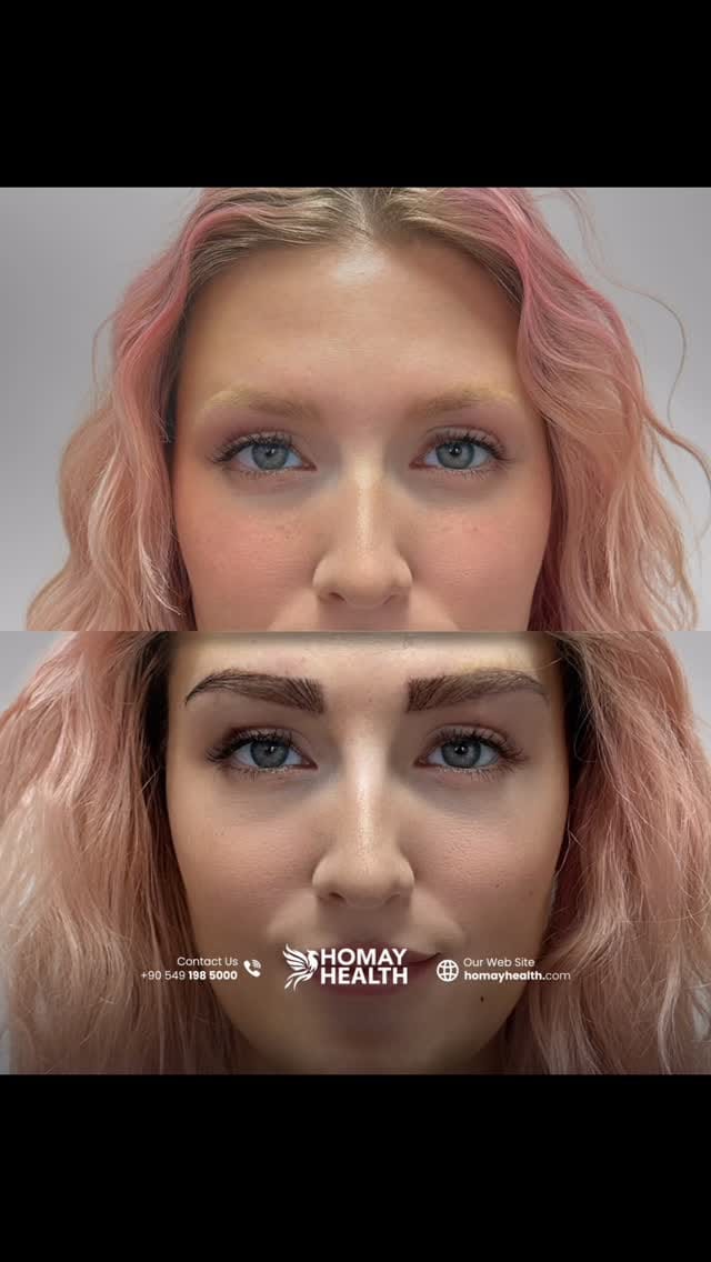 Post 8 by Eyebrow Transplantation on Instagram (video)