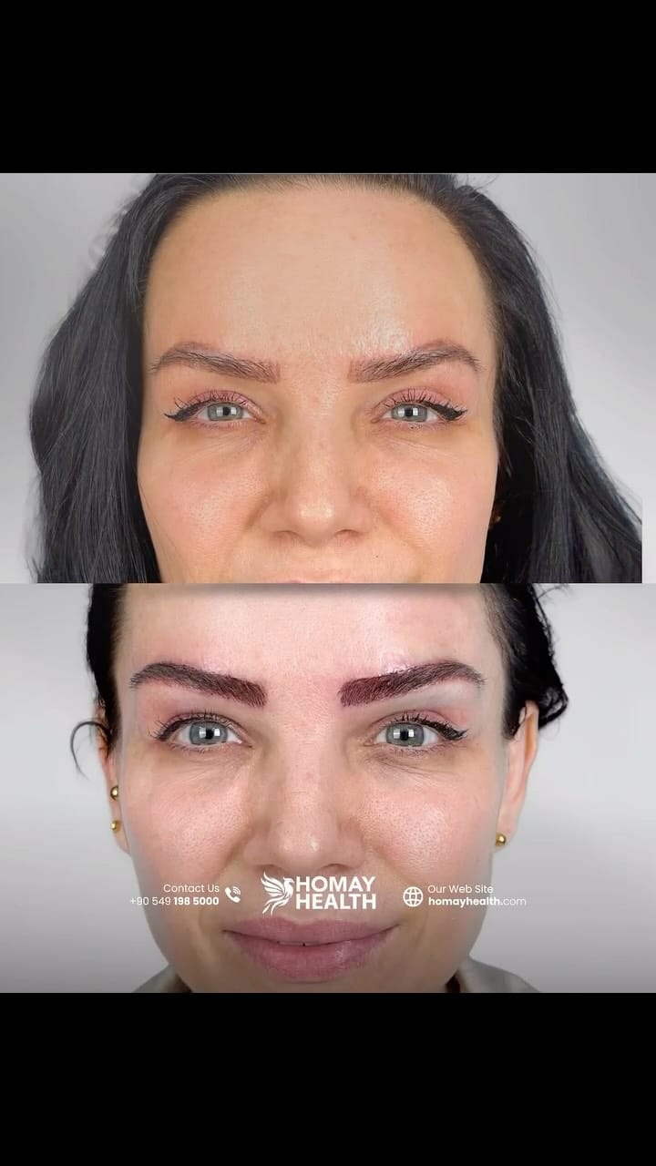 Post 6 by Eyebrow Transplantation on Instagram (video)