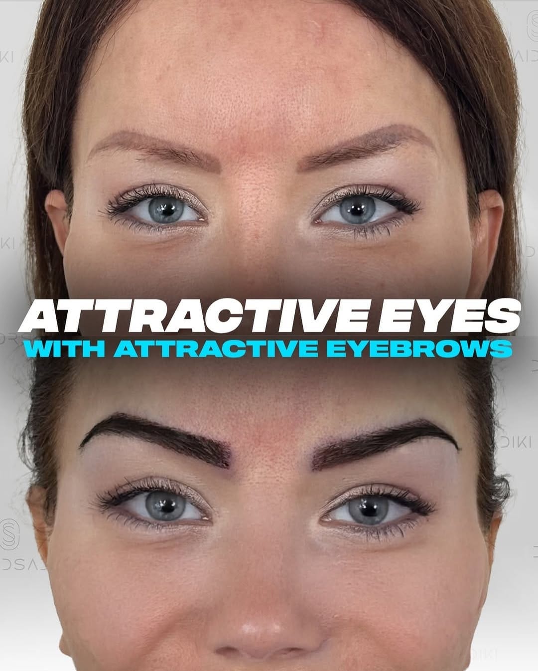 Post 5 by Eyebrow Transplantation on Instagram (image)