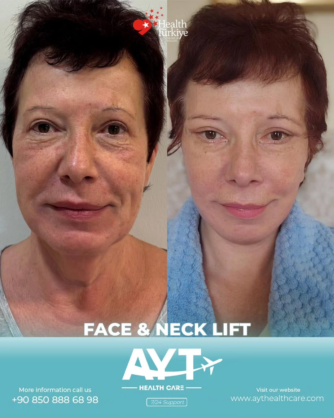 Post 6 by AYT Clinic 🇩🇪🇺🇸🇬🇧🇫🇷🇸🇦🇷🇺🇺🇦🇦🇿 on Instagram (image)