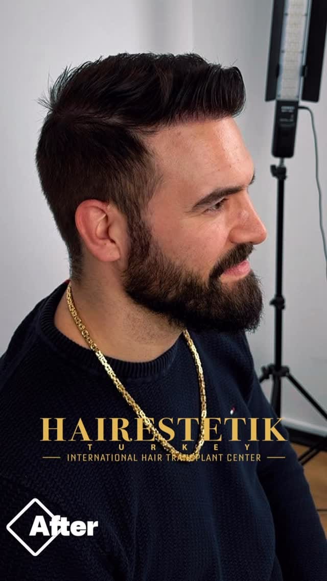 Post 4 by BY Engin Sönmez | Saç ekimi | on Instagram (video)