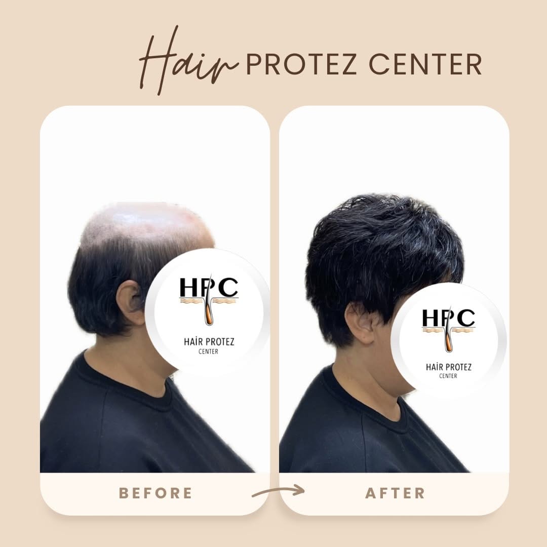 Post 7 by HAİR PROTEZ CENTER on Instagram (image)