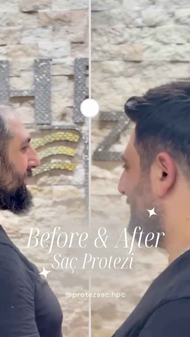 Post 9 by HAİR PROTEZ CENTER on Instagram (video)