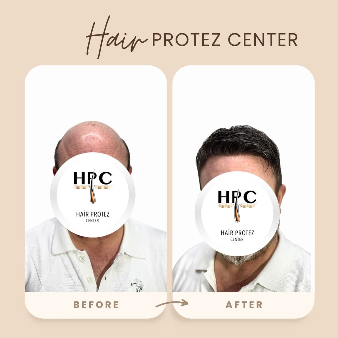 Post 6 by HAİR PROTEZ CENTER on Instagram (image)