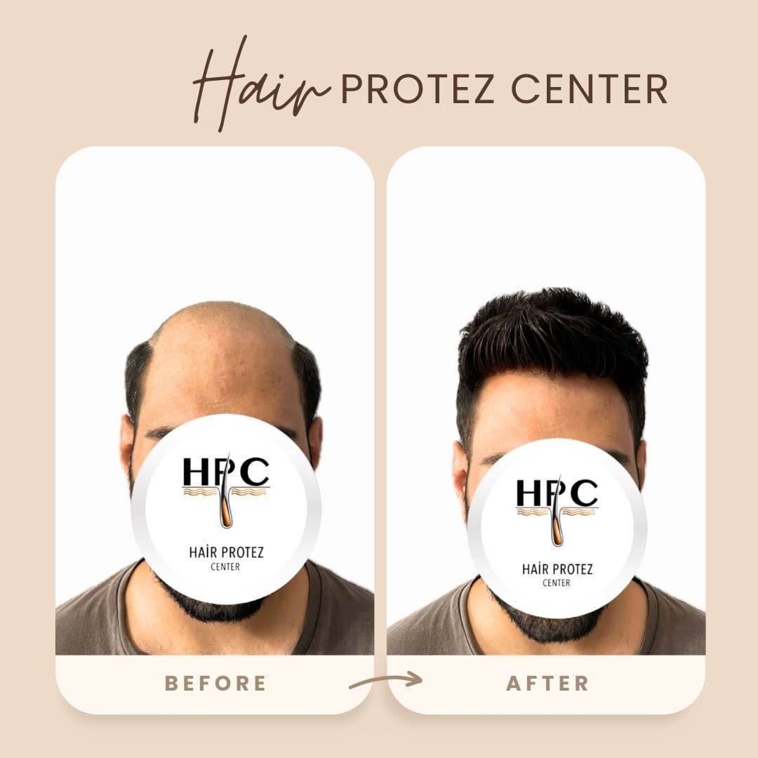 Post 5 by HAİR PROTEZ CENTER on Instagram (image)