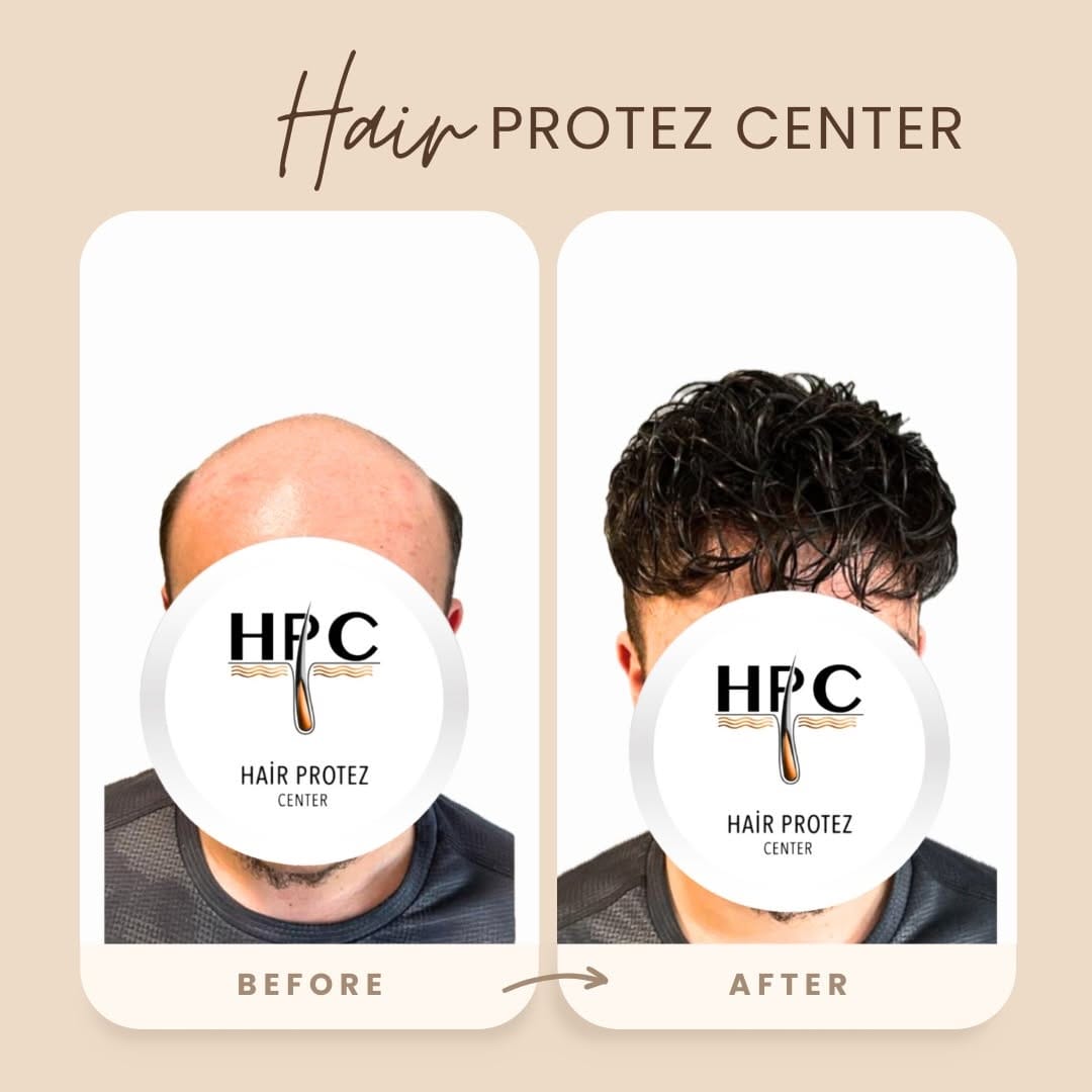 Post 4 by HAİR PROTEZ CENTER on Instagram (image)