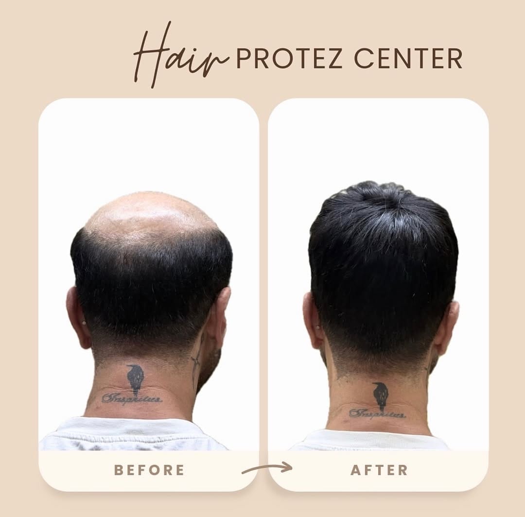 Post 2 by HAİR PROTEZ CENTER on Instagram (image)
