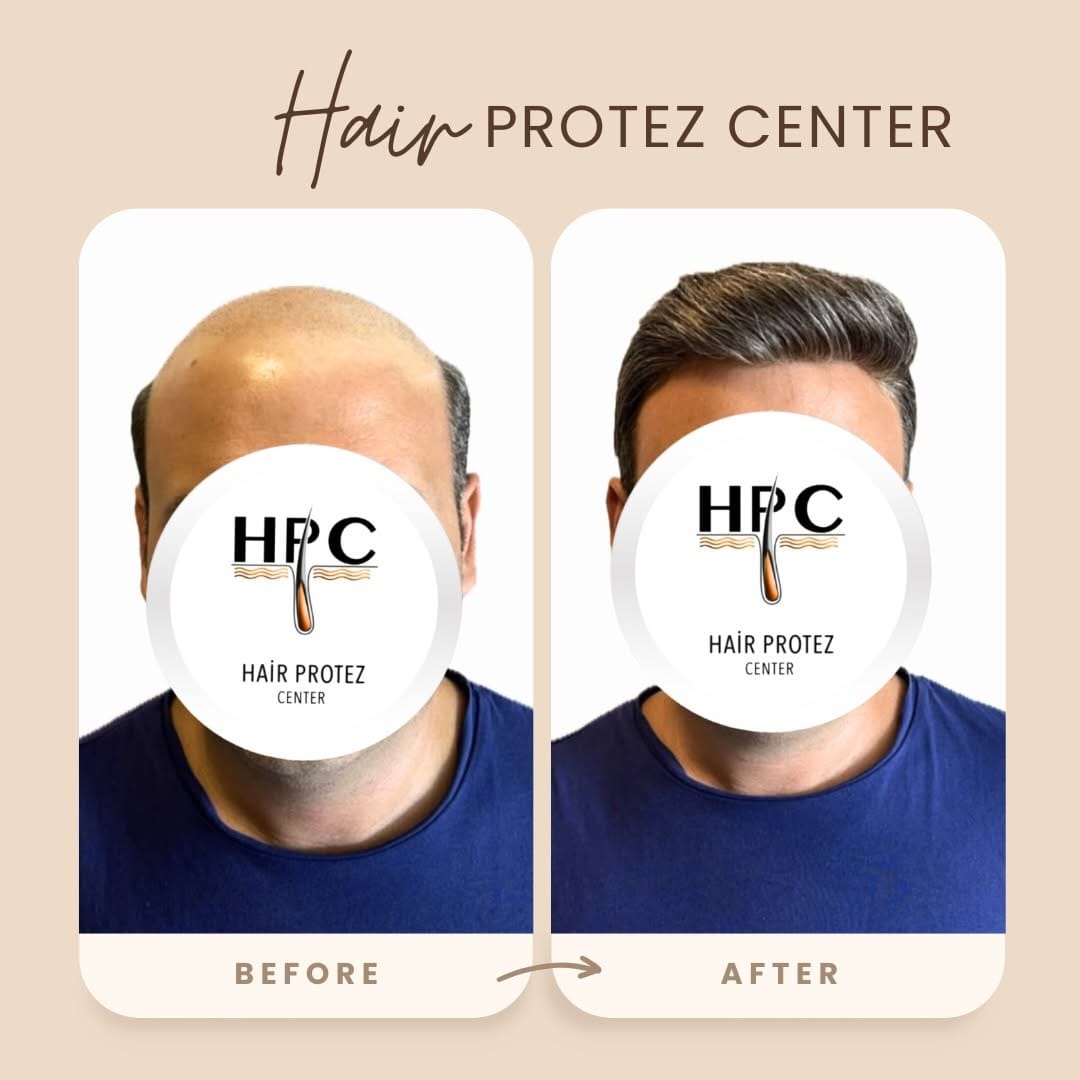 Post 1 by HAİR PROTEZ CENTER on Instagram (image)