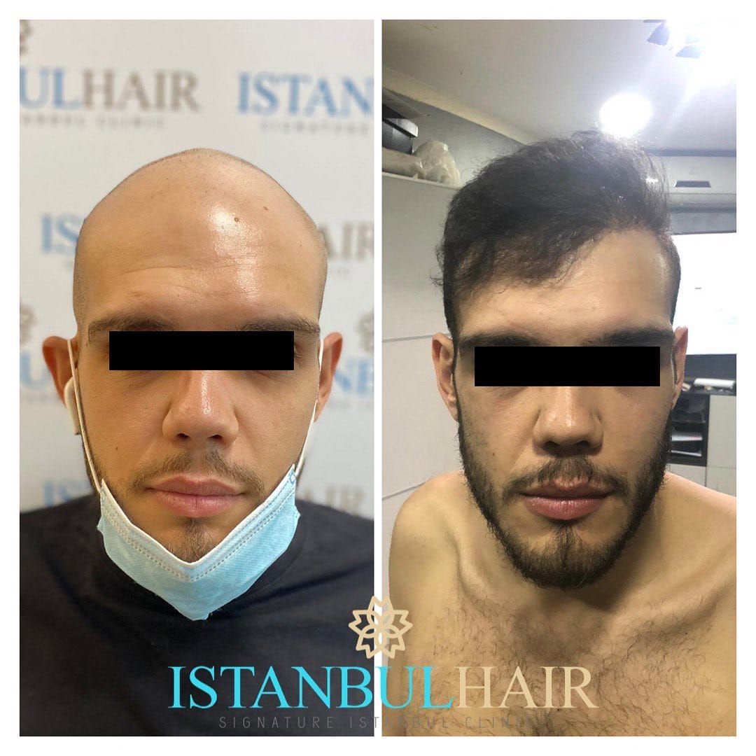 Post 9 by Istanbul Hair on Instagram (image)