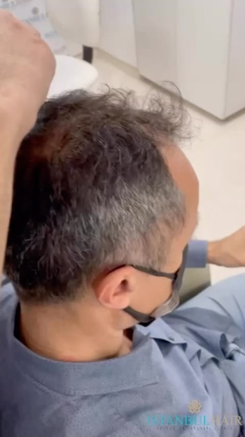 Post 4 by Istanbul Hair on Instagram (video)