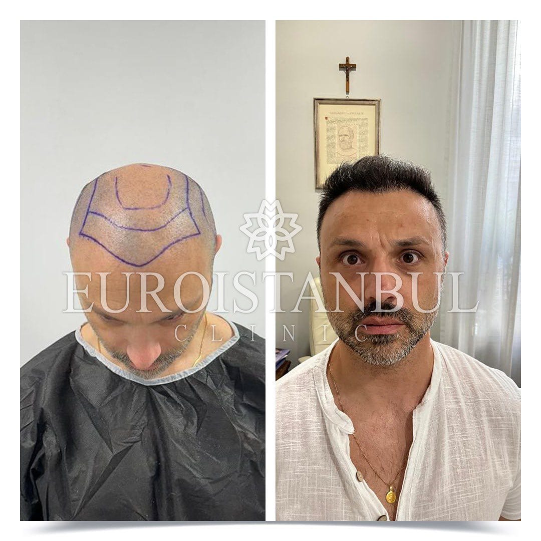 Post 1 by Istanbul Hair on Instagram (image)