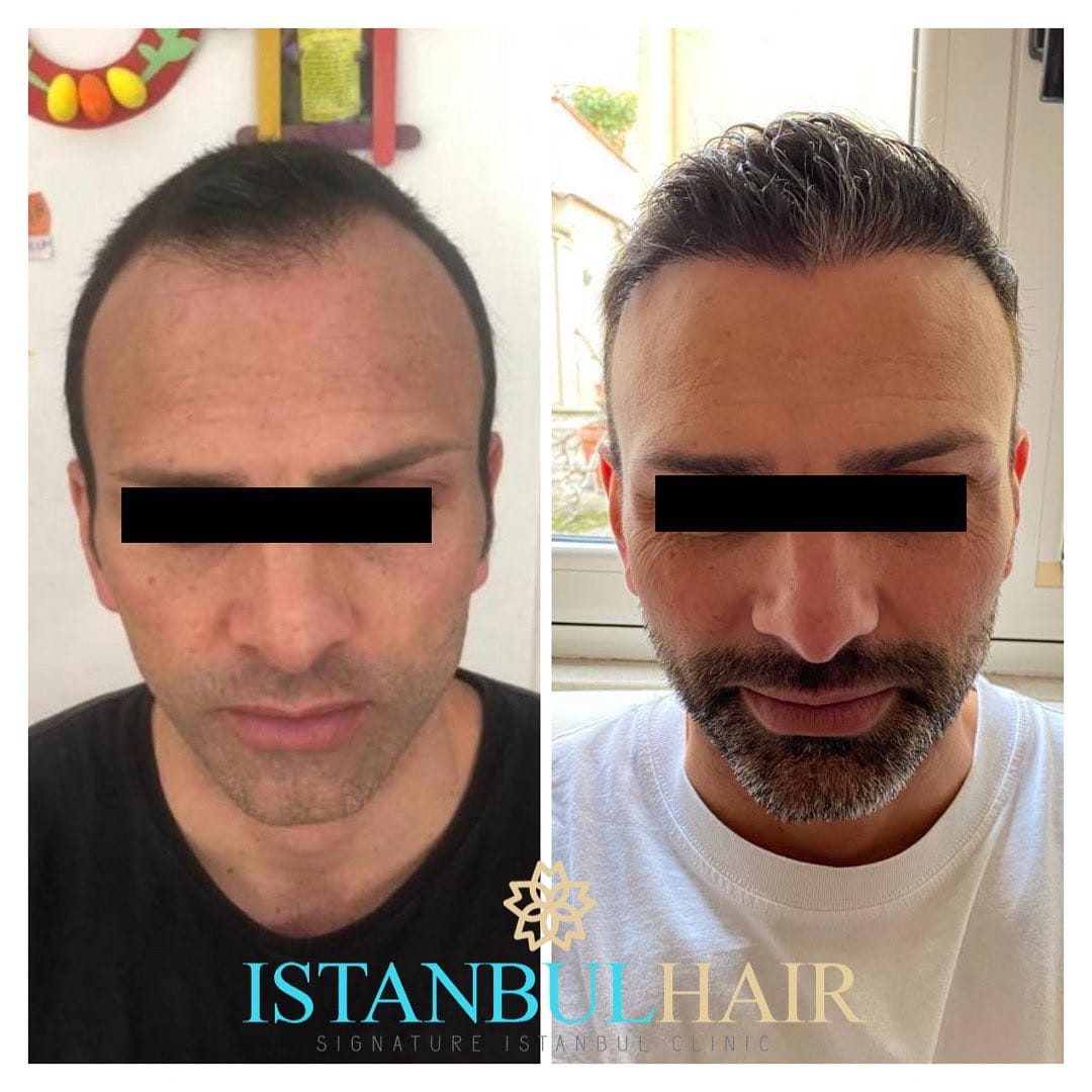 Post 7 by Istanbul Hair on Instagram (image)